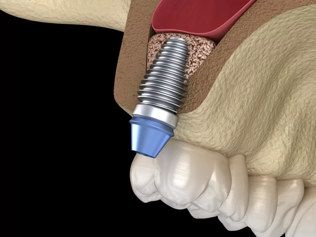 Sinus Lift- Dr Arman Barfeie Prosthodontist Official Website