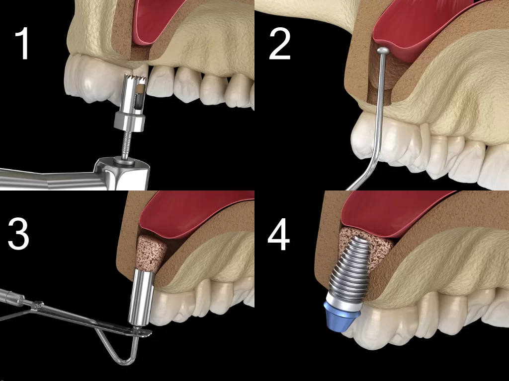 When Sinus Lift Is Recommended and what is the procedure ?